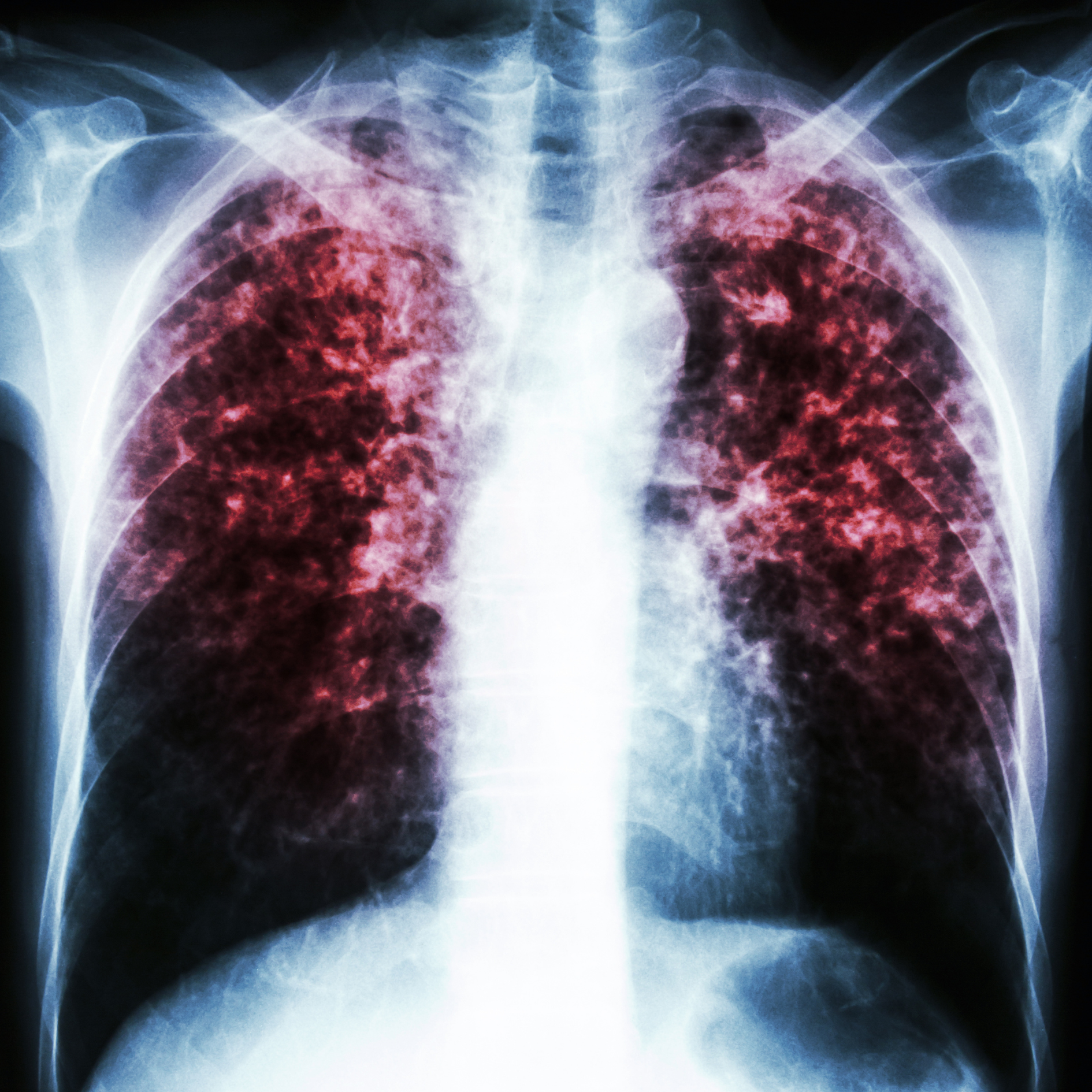 Mycobacterium avium complex (MAC) in air conditioners